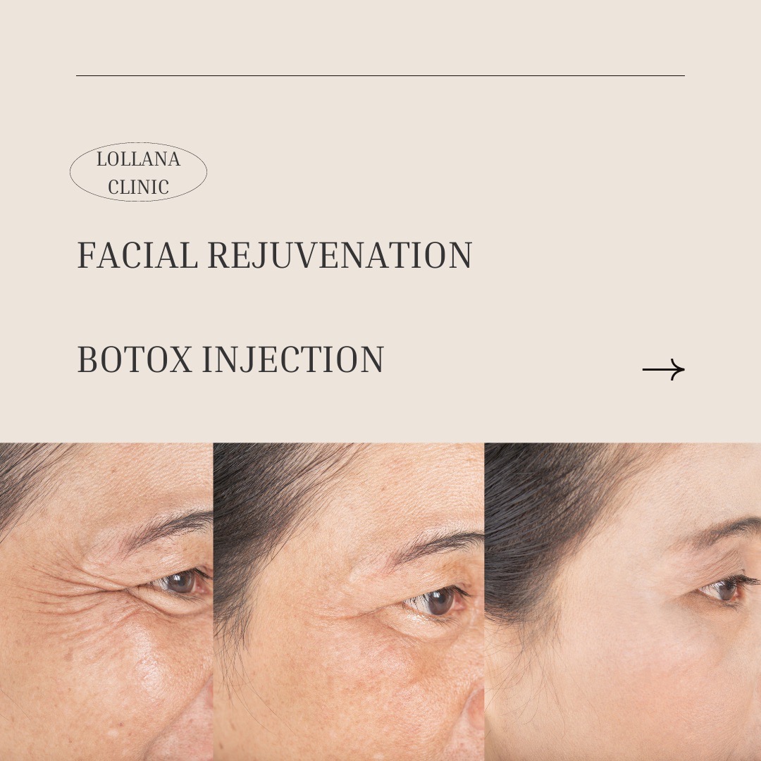 (Digital coupon) Lollana clinic Botox Nabota 100 units 11900 THB ดิจิทัลคูปอง Lollana clinic โบทอกซ์ นาโบตะ 11900 บาท ราคา 10,900 บาท*ส่งฟรี