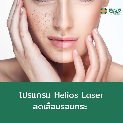 [E - Voucher] โปรแกรมแพคเกจ Helios Laser ( Freckles) ราคา 4,000 บาท*ส่งฟรี
