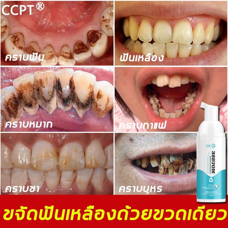 ?CCPT มูสแปรงฟัน ขจัดคราบฟัน คราบหินปูน ฟันเหลือง ฟันดำ คราบบุหรี่ เคลือบฟันให้ขาวใสดุจไข่มุก ทำให้ช่องปากสะอาดและสุขภาพ ฟอกฟันขาว ที่ฟอกฟันขาว เซรั่มฟอกฟันขาว น้ำยาฟอกสีฟัน ยาสีฟัน ยาสีฟันไวท์เทนนิ่ง ยาสีฟันฟอกฟันขาว น้ำยาทำความสะอาดฟัน ทำให้ฟันขาว