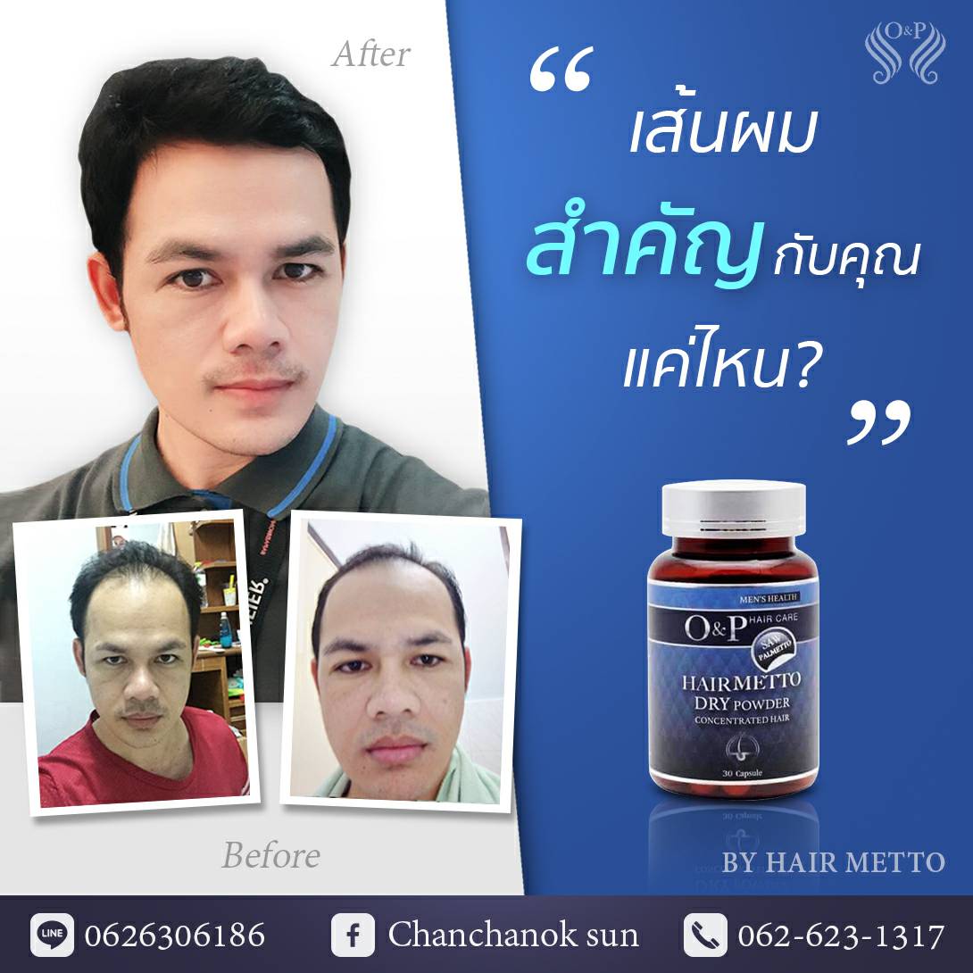 MERRMETTO สำหรับผู้ชาย(จำนวน30แคปซูล) รักษาผมร่วง ผมบาง ศีรษะล้าน