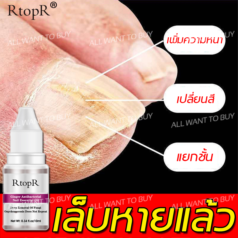 RTOPR บำรุงเล็บ (กำจัดเชื้อราที่เล็บ ดูแลเล็บ รักษาเล็บ เซรั่มรักษาเล็บ น้ำยารักษาเล็บซ่อมแซมเล็บ น้ำมันบำรุงเล็บ เซรั่มบำรุงเล็บ เชื้อราเล็บมือ เซรั่มเล็บ ออยบำรุงเล็บ ดูแลเตียงเล็บ  เซรั่มทาเล็บ รักษาเล็บขบ เล็บแตก  เล็บไม่เรียบ)Nails Repair Essence