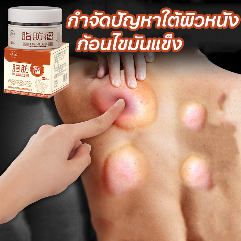 Lipoma removal cream ครีมก้อนเนื้องอกไขมัน ครีมทาเนื้องอกไขมัน 30g กำจัดปัญหาใต้ผิวหนัง ก้อนไขมันแข็ง เนื้องอกไขมัน